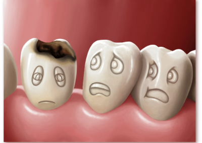 Tipuri de carii dentare